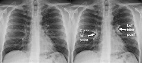 Imaging of Hila and Pulmonary Vessels 